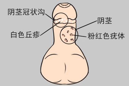 阴茎尖锐湿疣和珍珠样阴茎丘疹图