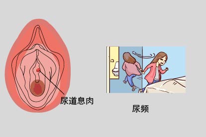 尿道息肉症状图片