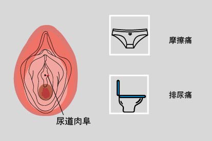 尿道肉阜症状图片