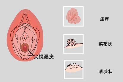 尖锐湿疣症状图片