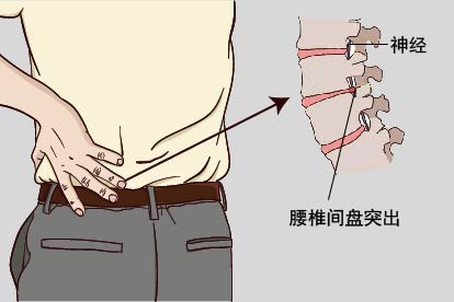 腰椎间盘突出图片