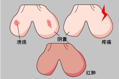 男性阴囊HPV感染图片