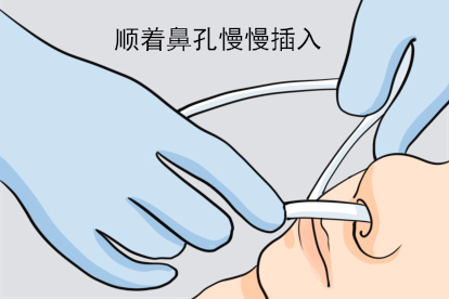 鼻饲管插管方法步骤三