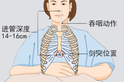鼻饲管插管方法步骤四
