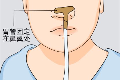 鼻饲管插管方法步骤五