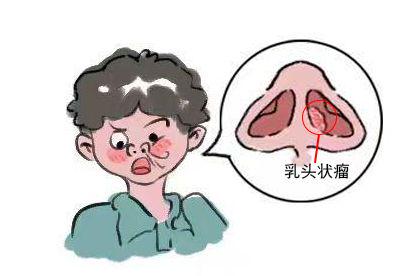 下鼻甲乳头状瘤呼吸困难图