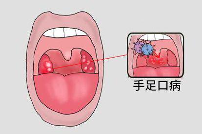 喉咙有疱疹手足口病图