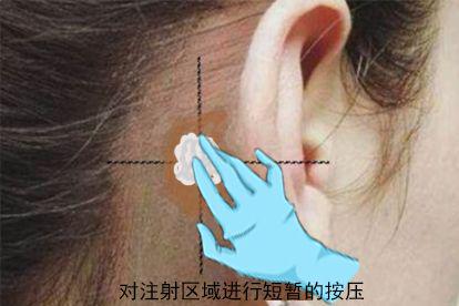 突发性耳聋耳后注射后按压