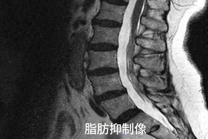 脂肪抑制像图片
