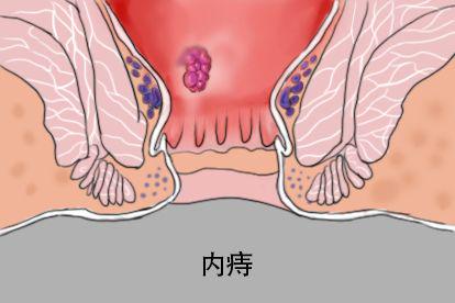 内痔图片