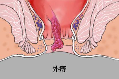 外痔图片