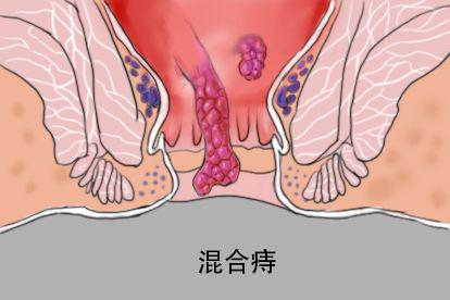 混合痔图片