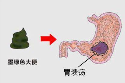 胃溃疡图片