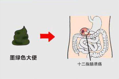 十二指肠溃疡图片