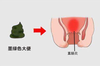 直肠炎图片