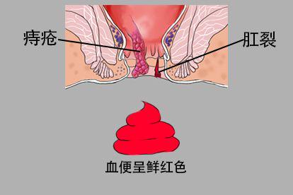 血便是鲜红颜色的图片