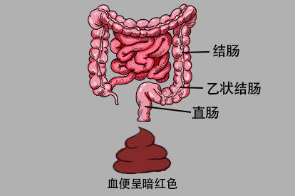 血便是暗红颜色的图片