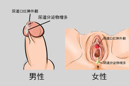 淋病尿道口红肿外翻及时就诊图片