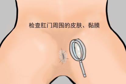 肛管炎早期诊断图片
