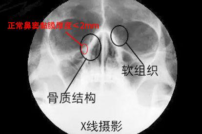 ct图像上鼻窦黏膜厚度图