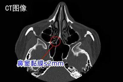 ct图像上鼻窦黏膜厚度图