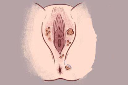 hpv6尖锐湿疣图片