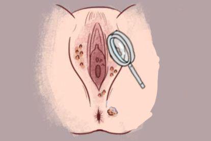 hpv6尖锐湿疣诊断图片