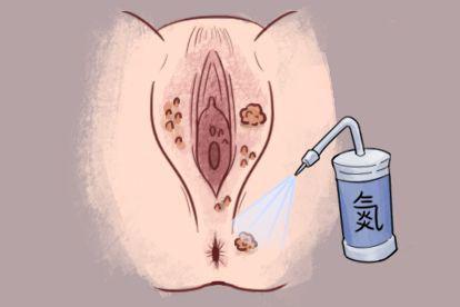 hpv6尖锐湿疣治疗图片
