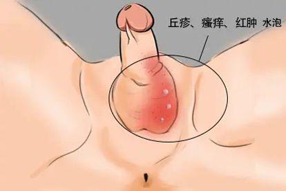 阴茎体长水泡阴囊湿疹图