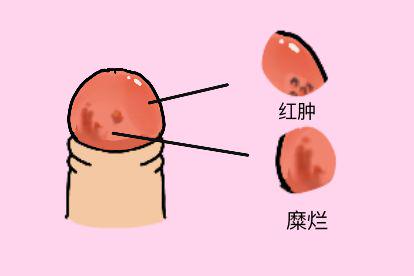 包皮龟头炎图