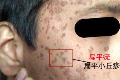 男性hpv16感染扁平疣图片