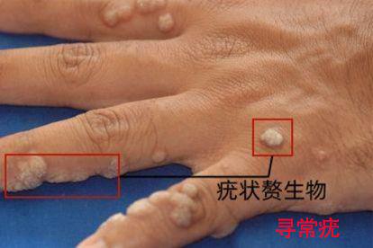 男性hpv16感染寻常疣图片