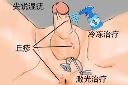 尖锐湿疣图