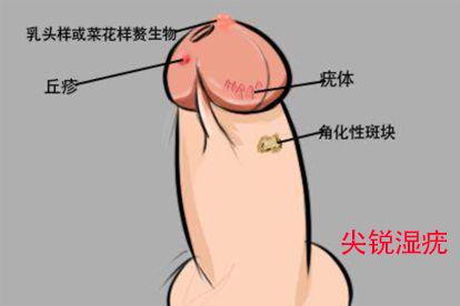 男性hpv16感染尖锐湿疣图片
