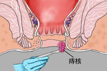 单个痔核脱出药物治疗图