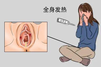 女性梅毒初期发热图片