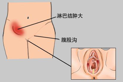 女性梅毒初期淋巴结肿大图片