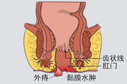 外痔脱肛肛门坠胀感图片