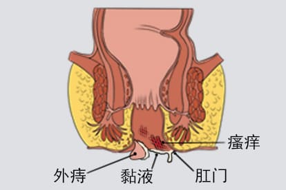 外痔脱肛瘙痒图片
