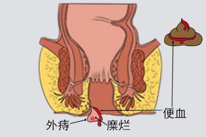 外痔脱肛便血图片
