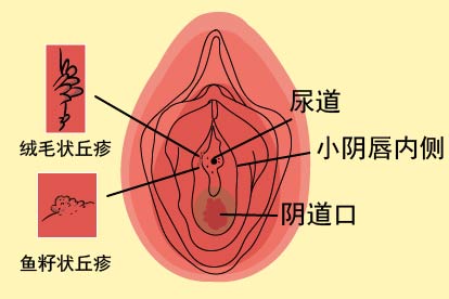 假性湿疣图片
