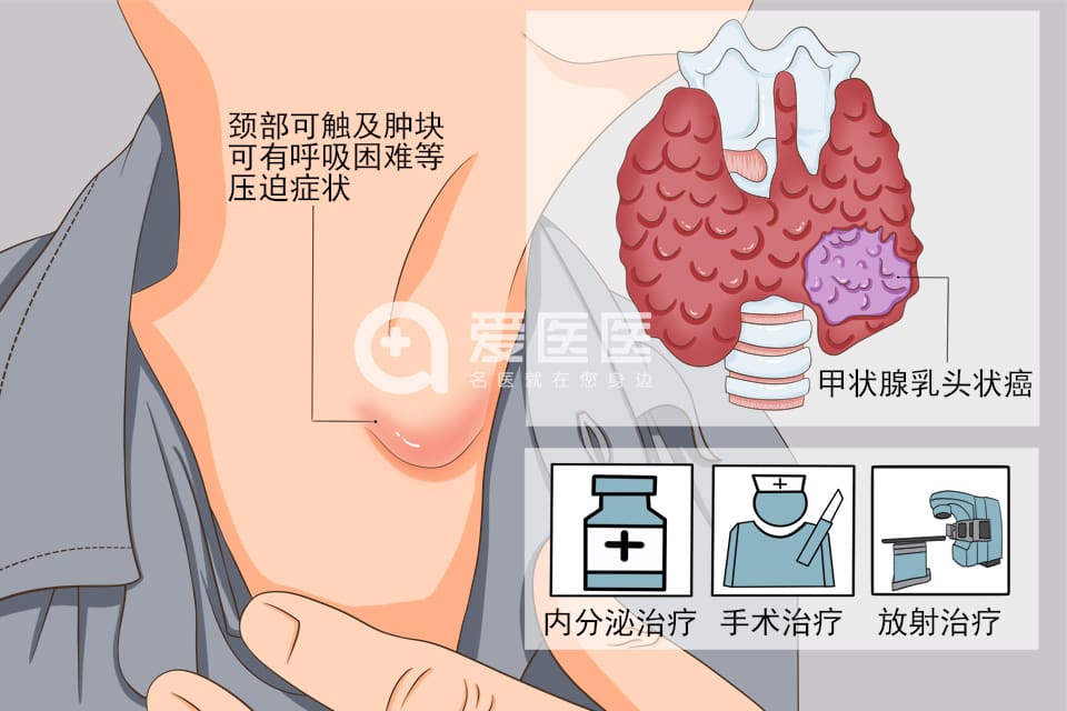 甲状腺乳头状癌