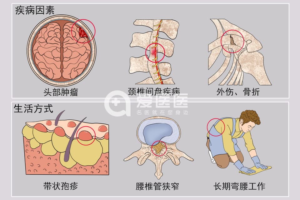 神经痛