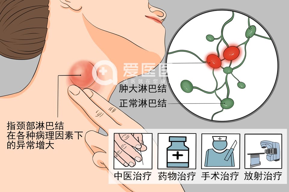 颈部淋巴结肿大