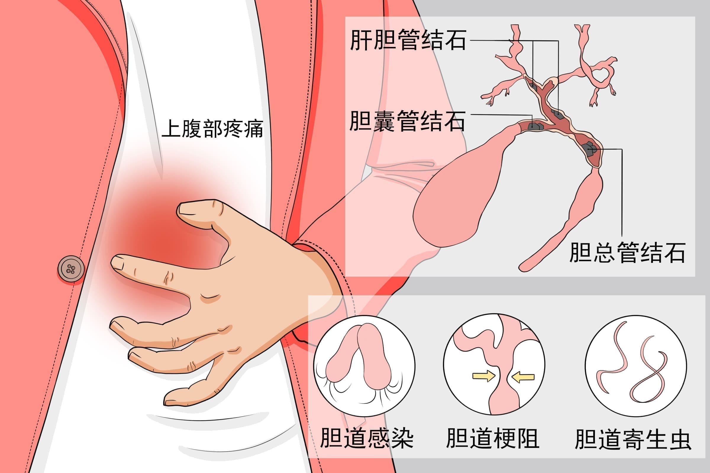 胆管结石