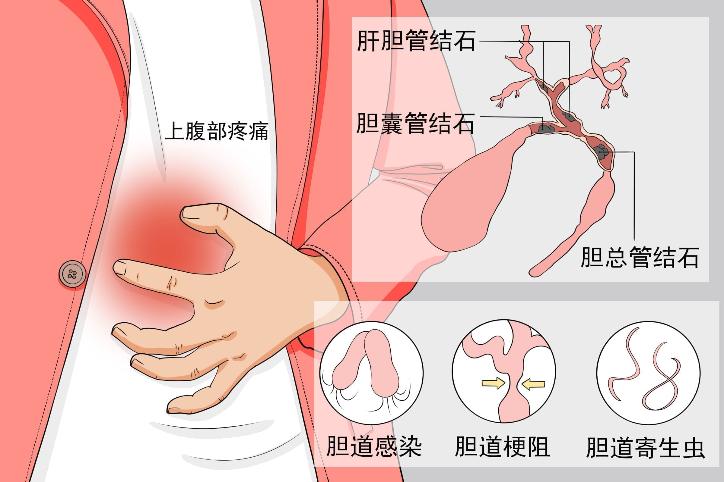 胆管结石