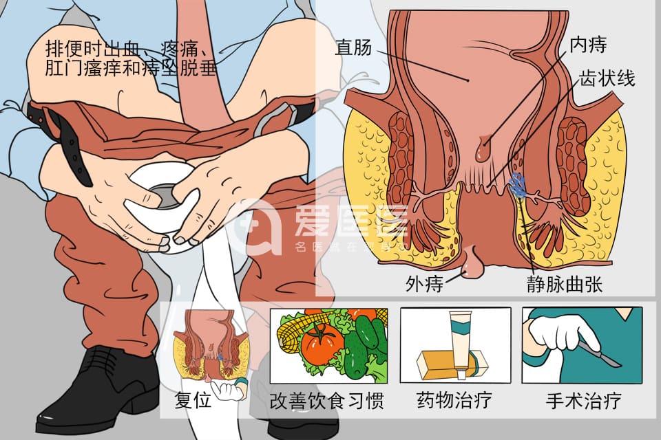 痔疮