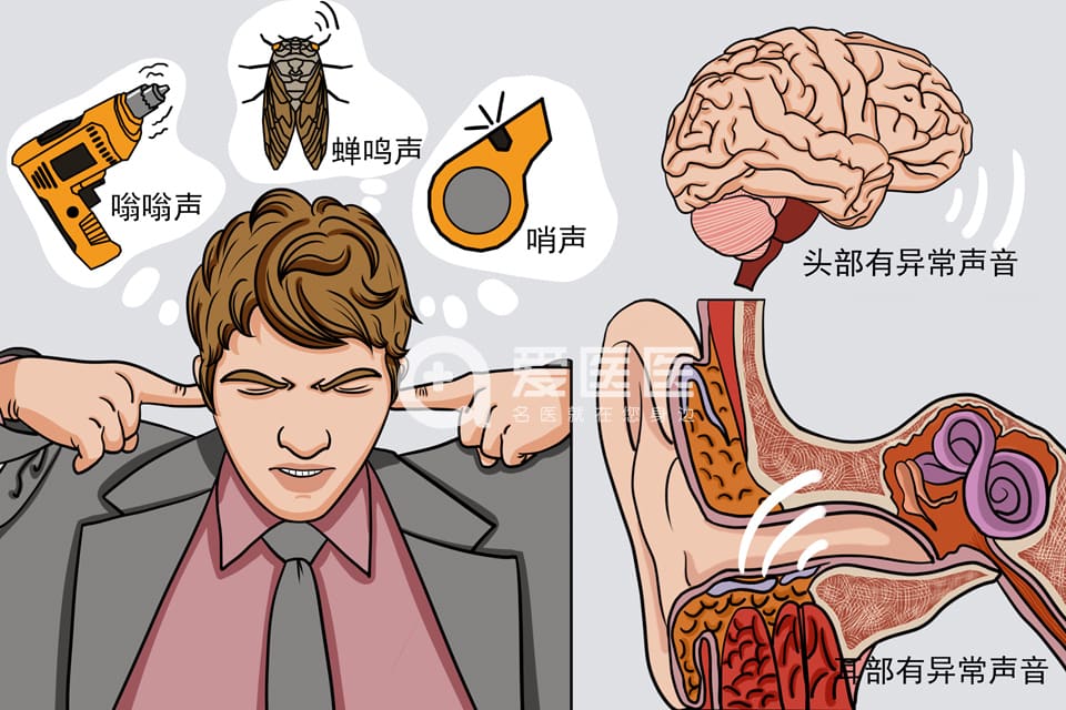 神经性耳鸣