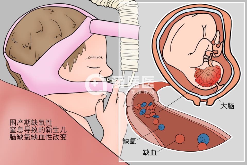 新生儿缺氧缺血性脑病