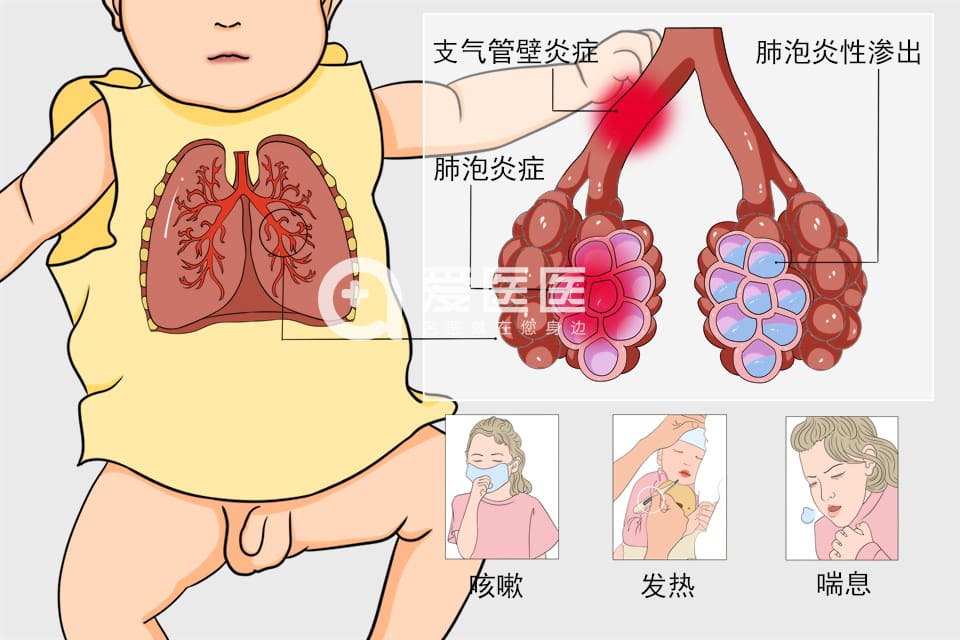 小儿支气管肺炎